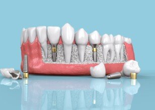 Beyond Aesthetics: Functional Benefits of Dental Implants